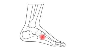 symptoms of plantar fasciitis