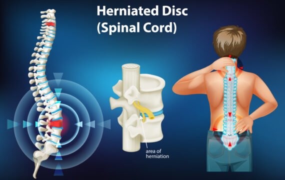 chiropractor herniated disc frisco